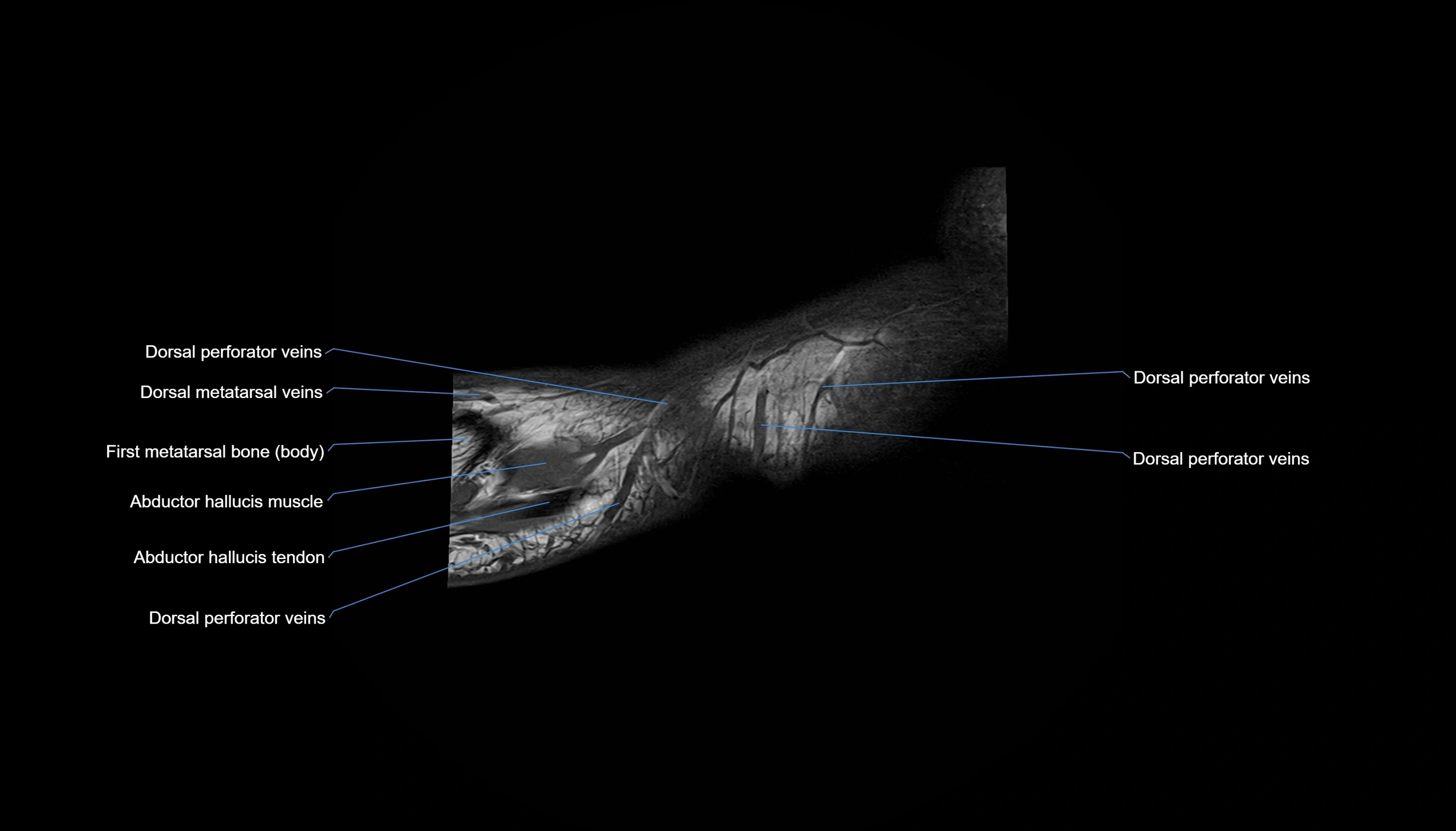 MRI mid foot sagittal cross sectional anatomy 3T  radiology  image-img-00001-00040.webp